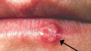 Como curar herpes labial rapidamente sem dores