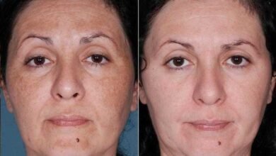 Máscara milagrosa para melasma e manchas no rosto fr